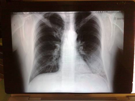 pneumoniapix.jpg